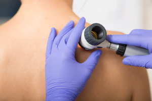 skin cancer Red Hill